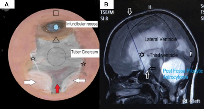 Glioma Surgery